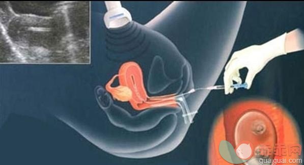 冷冻卵子到底有没有“卵”用？看了就知道