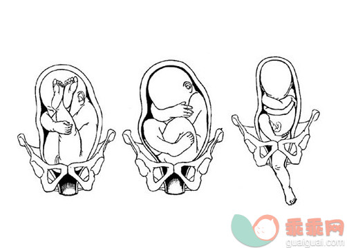 分娩知识：3种常见的胎位不正姿势