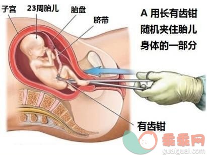 什么是引产？如何引产？（图解）