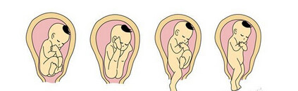 正常胎位图和胎位不正图（图）