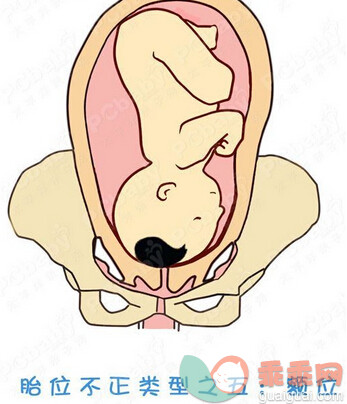正常胎位图和胎位不正图（图）