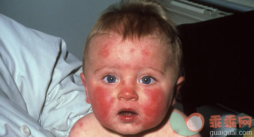 婴儿传染性红斑的病因和症状