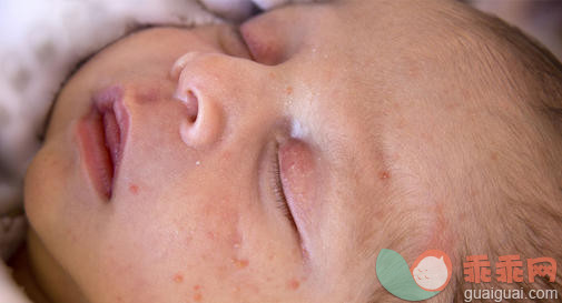 美国医生建议的治疗婴儿湿疹的方法