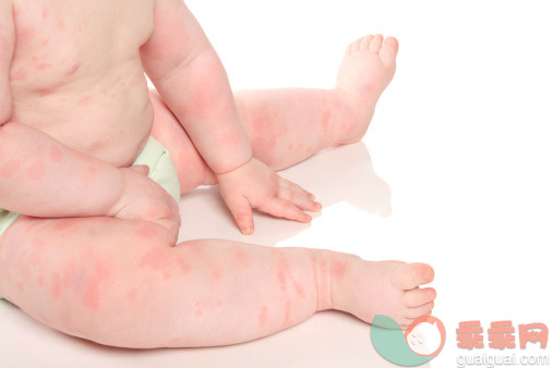 婴儿湿疹症状和原因