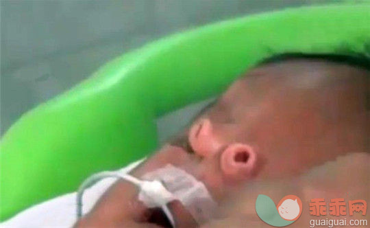 不可思议！这个刚出生的小婴儿居然长了两个鼻子