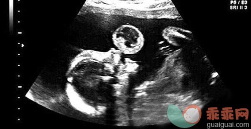 孕检B超显示胎儿在吐泡泡 原来是良性肿瘤