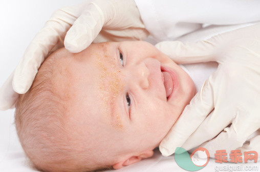 干净,生活方式,健康保健,人的脸部,快乐_163206873_Baby with seborrheic dermatitis_创意图片_Getty Images China