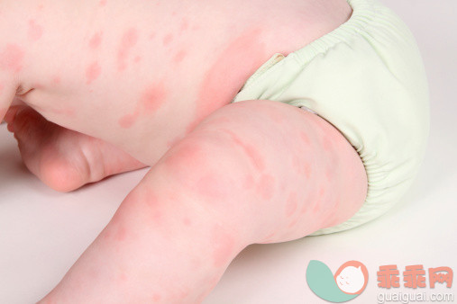 过敏性荨麻疹症状 过敏性荨麻疹怎么办