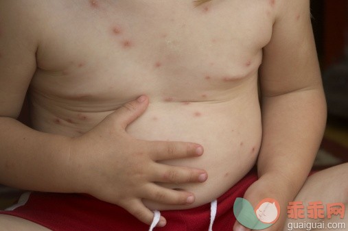 人,健康保健,室内,手,白人_128898661_1 year old boys tummy covered in chicken pox_创意图片_Getty Images China